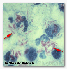 bacilos_hansen.gif