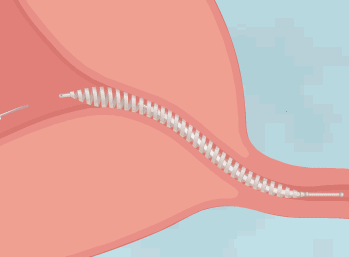 Mini mola - Esterilização sem cirurgia deve substituir laqueadura