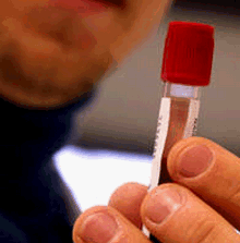 VDRL, exame para diagnosticar sífilis pode apresentar falso positivo