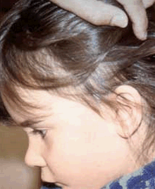 Alerta: Piolho prejudica o aprendizado pode até causar anemia, e alunos discriminados