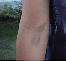 Laboratório - Causas e tratamentos de hematoma após a coleta de sangue
