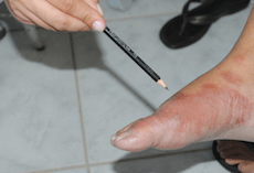Hanseníase (lepra), teste de sensibilidade e exame de laboratório