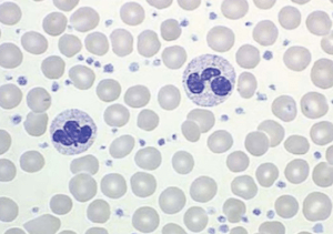 plaquetas aumentadada leucocitose