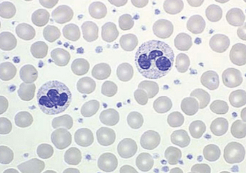 Plaquetas altas no resultado do exame de sangue, a plaquetocitose,  trombocitose ou plaquetose, o que pode ser | Plugbr.net