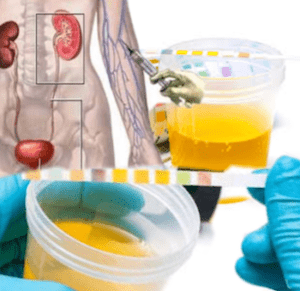 alteração em exame de urina após uso de contraste